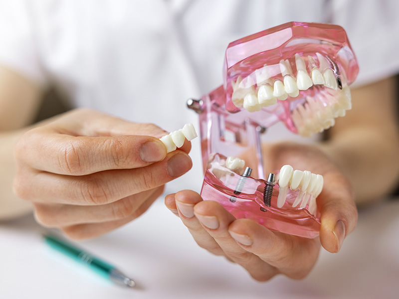 Hand holding a tooth model with an open mouth, revealing sharp teeth and gum line.